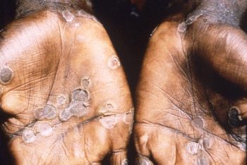 Monkeypox: How it spreads, who’s at risk – Here’s what you need to know