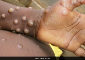 Monkeypox: Experts give virus variants new names