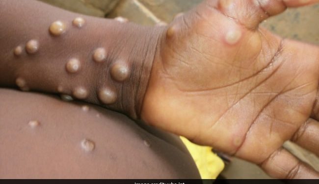 Monkeypox: Experts give virus variants new names
